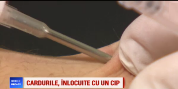 Image result for cip implantat sub piele